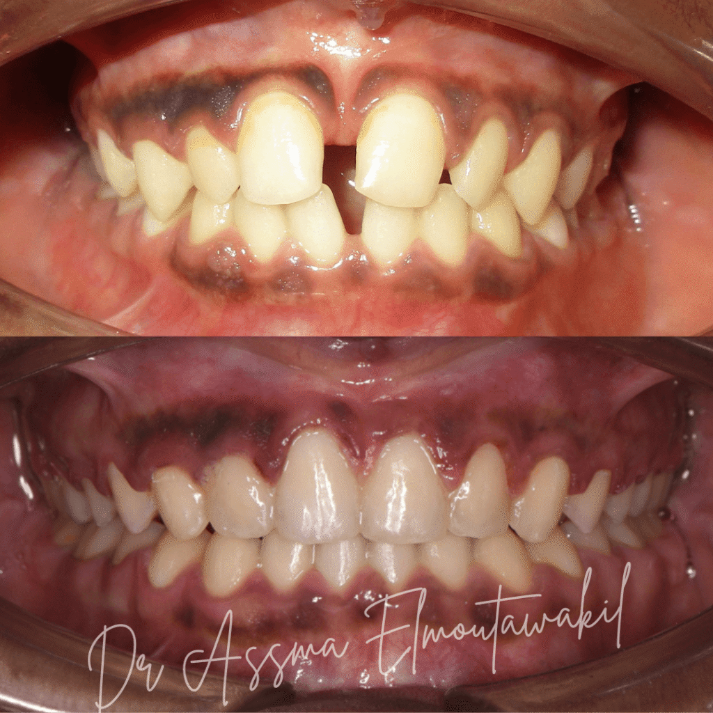 fermeture diasteme bague orthodontiste gueliz marrakech