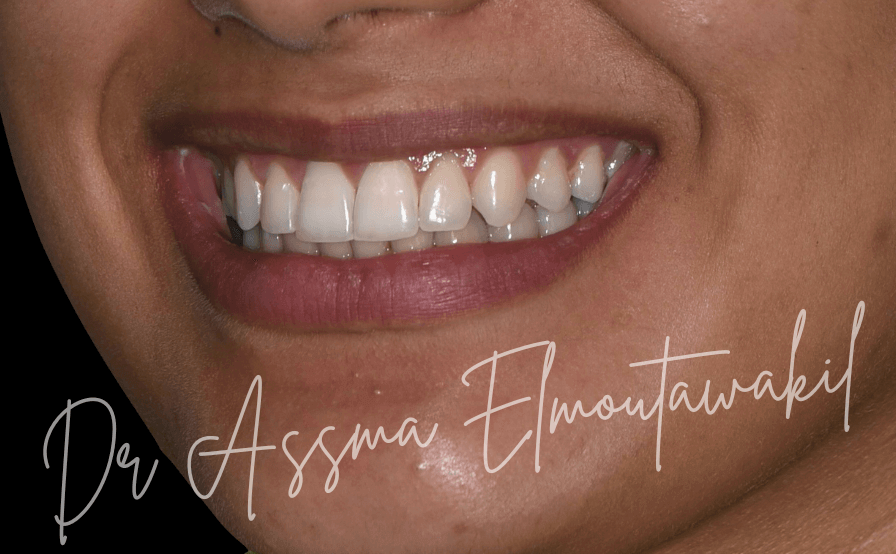 Sourire parfait resultat de orthodontie et blanchiment gueliz marrakech