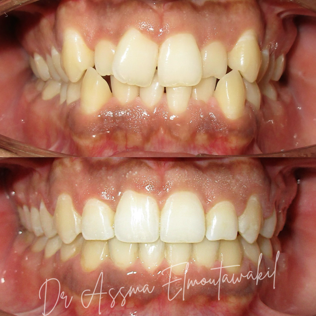 alignement dents par traitement orthodontique gueliz marrakech