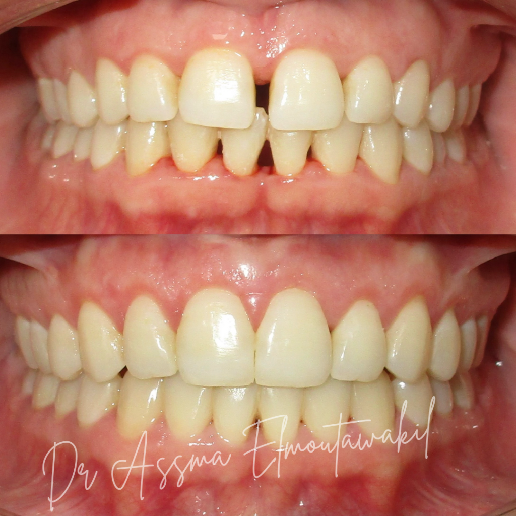 fermeture DIASTEME par orthodontie et gingivectomie dentiste gueliz marrakech
