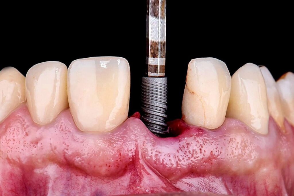 mise en place d'un implant dentaire