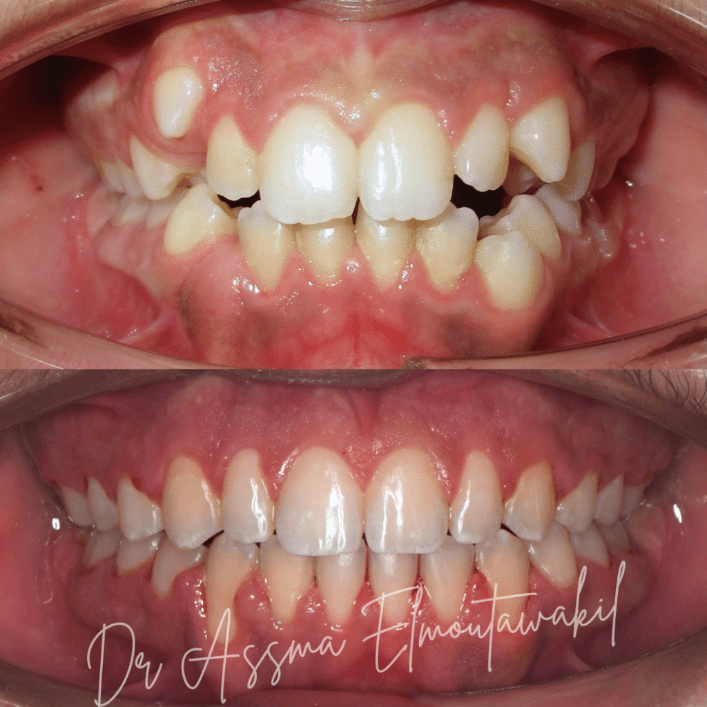 traitement orthodontique bague gueliz marrakech