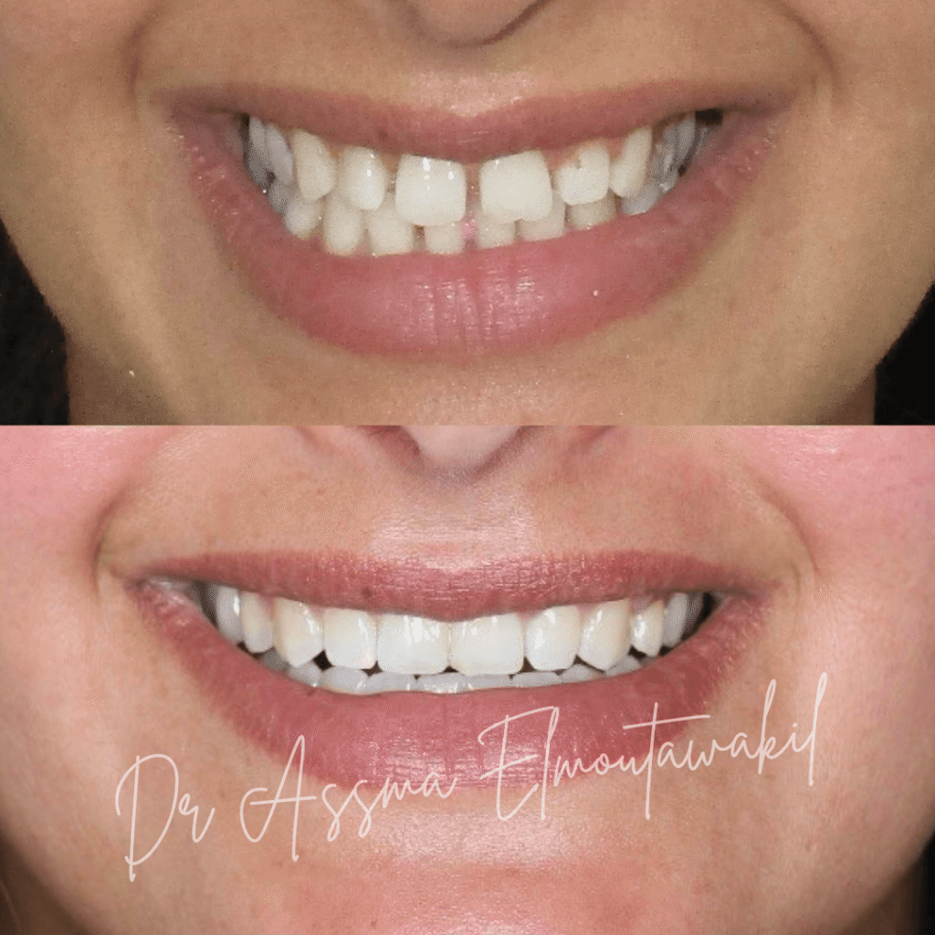 sourire fermeture diastemes par orthodontie gueliz marrakech