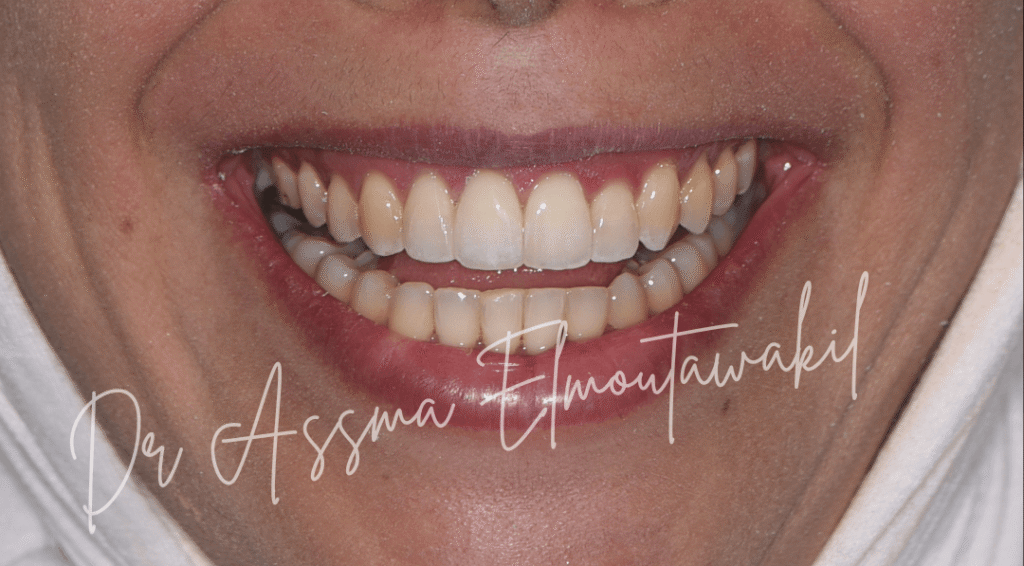sourire resultat de orthodontie a gueliz marrakech