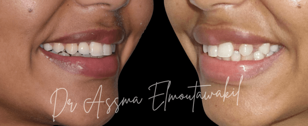 bridge colle agénésie des latérales orthodontiste gueliz marrakech