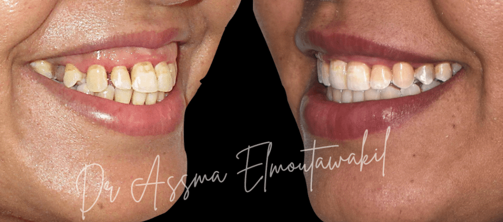 fermeture diastoles par orthodontie gueliz marrakech