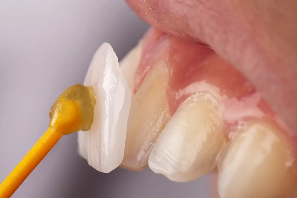 mise en place d'une facette dentaire