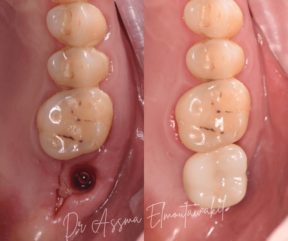 implant dentaire gueliz marrakech