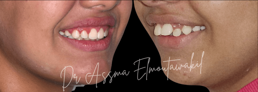 traitement biproalveolie par orthodontie gueliz marrakech