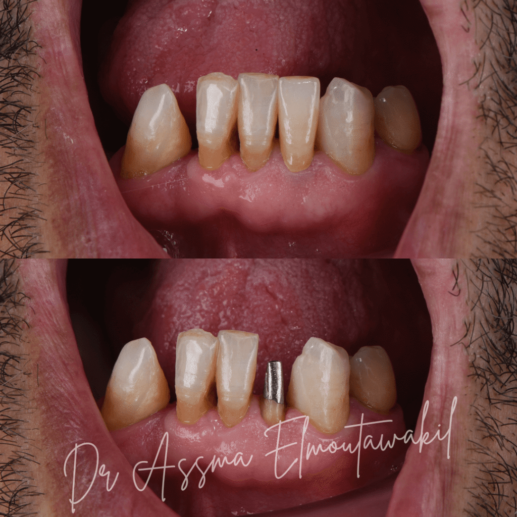 colonne dentaire zircone gueliz marrakech